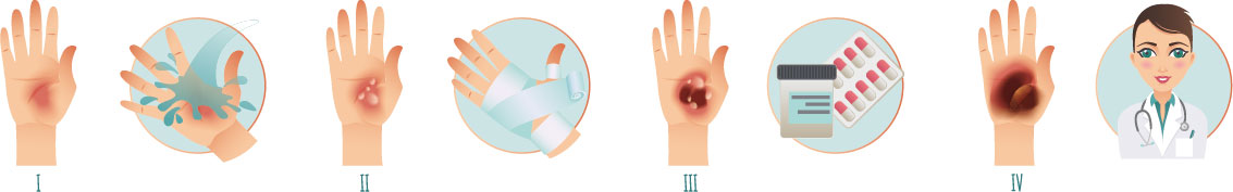 Erste Hilfe Verbrennung